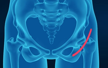 Benefits of Anterior Approach Hip Replacement