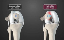 Tibial Tubercle Osteotomy