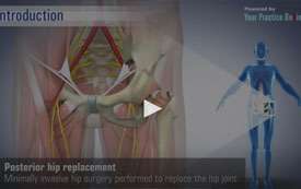 Posterior Hip Replacement