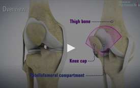 Patellofemoral Instability