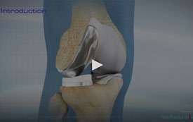 Uni Knee Replacement