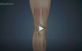 Revision Knee Replacement